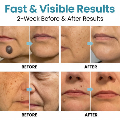 Mole & Wart Removal Laser Pen